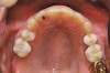 Fig 11. Corticotomy SFOT. A 42-year-old male presented with a history of extraction orthodontic therapy.