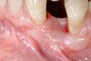 Figure 8  Adequate keratinized and attached gingiva after free gingival graft surgery.