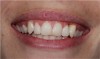 Figure 8 The high smile with the significant loss of papilla and “black triangle” presented a clinical dental and a psychological problem for the patient.