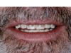 Figure 15. Upper and lower mock veneers almost touching, allowing a clear, hissing sibilant sound.