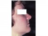 Figure 8. The lower one third of face seems shortened and the upper lip is not well supported and appears thin.