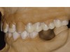 Figure 16 THROUGH 19. Complete full mouth wax-ups after final determination of 3D VDO.