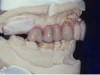 Figure 20. Diagnostic set-up for 14 individual
implant-retained crowns.