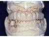 Figure 21. Temporary prosthesis made from the diagnostic set-up. Note the exaggerated cervical contours for lip and cheek support. These will be evaluated and modified as needed during the provisional evaluation of the 3D VDO for esthetic, function, and comfort parameters. (Figures 14 through 19 appear courtesy of Tufts University School of Dental Medicine, Division of
Graduate Prosthodontics).