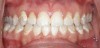 Figure 1  Poor oral hygiene during orthodontic treatment can result in decalcified and carious enamel at the end of treatment. (Photograph courtesy of Dr. Andrew Kious.)