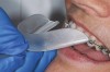 Figure 3  The path of insertion of the tray should be from the facial. Try in the tray with the patient before heating to ensure a proper path of insertion and full patient understanding of relaxing the lip.