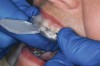 Figure 4  After the softened tray is seated correctly, quickly apply finger pressure on the facial and lingual of the tray to adapt to the gingival areas, starting from the midline and proceeding distally.