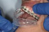 Figure 7  Remove the custom-fitted tray that has been made directly in the mouth over the orthodontic brackets.