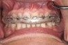 Figure 9: Once it is trimmed, the patient will have a smooth comfortable tray for applying the 10% carbamide peroxide that covers the anterior brackets, which also protects the cheeks and provides a comfortable MI occlusion.
