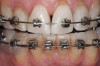 Figure 13  Any yellow or discolored areas on the teeth will generally be attributed to the composite bonding material, which penetrates 25 µm into the enamel, and must be removed by abrasion.