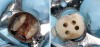 Fig 3. After decay and old restorative material removal to access the canal orifices, the tooth is potentially left in a weakened condition (left); after a pre-endodontic buildup to reinforce the remaining tooth while allowing access to the canals for endodontic treatment (right).