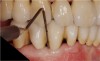 Figure 18 The 10-year clinical evaluation revealed periodontal health at the regenerated site with minimal periodontal probing depth.