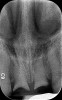 Fig 8. Radiograph of nonrestorable maxillary central incisors.