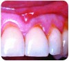 Figure 1—Gingival recession. Gingival recession leads to exposed dentin. If the dentin tubules are open to the oral cavity, dentin hypersensitivity will likely occur. The differences between sensitive and non-sensitive dentin are not apparent to the naked eye. Image courtesy of Li.