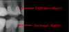 Figure 5. Radiograph shows restoration that used sectional matrix (below), which is specifically designed to establish proximal contacts as well as contour compared to one using a traditional Tofflemire matrix (above).
