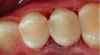 Figure 9. The identical height of the restored marginal ridge as compared to adjacent tooth due to the careful placement of the matrix.