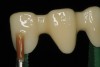 Figure 18 A coat of shade base stain is applied to the zirconia substructure and fired before applying the veneering porcelain.