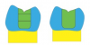 Fig 1. Left: the conventional method using 2-mm layers. Right: a diagram of a restoration using a bulk fill for the 5-mm increment.