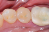 Fig 3. Finished Class II restoration using bulk-fill posterior dental composite.