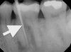 Radiographic confirmation of periradicular diagnosis—chronic apical on tooth No. 19. Note the tracing of the inserted gutta-percha to the etiology. Local anesthesia is generally not required for a sinus tract tracing.