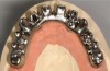 Fig 8. The full-arch titanium framework, which will receive individual lithium-disilicate crowns.