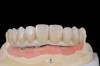 Fig 10. The full-arch zirconia framework with individual lithium-disilicate crowns, which were individually luted
in the laboratory.
