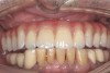 Fig 12. Acrylic wraparound
titanium bridge framework with acrylic resin teeth.