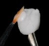 Fig 3. Leucite-reinforced incisal porcelain is placed in the incisal region.