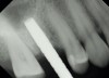 (7.) Radiograph of the osteotome in the site to verify depth in relation to the sinus floor with needed sinus elevation height.