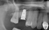 (13.) Radiograph immediately following implant placement with cover screw on the implant.