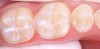 Fig 2. Sealants placed: mandibular first molar and second molar.