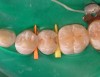 Fig 3. Minimally invasive Class II slot preparation: mandibular second premolar.
