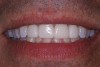 Fig 11. Immediate postoperative view of porcelain veneers and all-ceramic crown placed using a light-cured resin cement for the veneers and crown.