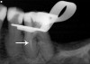 Fig 4. Radiographic example of a separated endodontic rotary NiTi file.