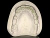 Fig 7. Definitive maxillary cast utilizing thermoplastic heat shapeable tray; the use of VPS shows detailed vestibular areas and tooth structures.