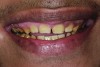 Figure 1. Preoperative frontal smile of patient suffering from AI, showing small, discolored, worn teeth.