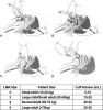 Figure 4. Insertion of supraglottic airways (SGA) and suggested sizes. (A) The tip of the cuff is pressed upward against the hard palate by the index finger, while the middle finger opens the mouth. (Insertion is often facilitated by adding a small volume of air [approximately 5 mL] to the cuff.) (B) The SGA is pressed backward in a smooth movement. Notice that the nondominant hand is used to extend the head. (C) The SGA is advanced until definite resistance is felt. (D) Before the index finger is removed, the nondominant hand presses down on the SGA to prevent dislodgment during removal of the index finger. The cuff is subsequently inflated fully, and outward movement of the tube is often observed during this inflation (courtesy of LMA North America Inc, San Diego, CA).