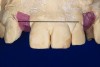 Fig 12 through Fig 14. An implant has been placed at a normal depth relative to the bone and tissue level of the site (Fig 12); however, it will be impossible to create a restoration the same length as the contralateral tooth due to the coronal placement of the implant (Fig 13). As demonstrated in the provisional restoration shown in Fig 14, the tooth length discrepancy is significant.