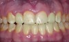 Fig 6. All-ceramic (IPS e.max) crowns delivered with incisal composite restorations on the central incisors.