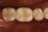Fig 12. Delivered all-ceramic crowns (e.max CAD) for No. 30 and No. 31.