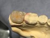 Fig 5. Tooth No. 18 is fully functional with an outstanding esthetic result.
