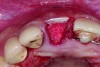 Placement of PTFE membrane to form the missing buccal bone. - See more at: http://cdeworld.com/courses/4756-Site_Preparation_for_Implant_Replacement_in_the_Esthetic_Zone#sthash.O5zxOUde.dpuf