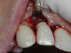 Fig 1. This implant was placed in March 2006. Peri-implantitis was clinically evident in April 2008, with bleeding on probing, suppuration, and increasing probing depth.