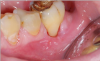 Fig 4. Dental lasers can be used for restorative procedures that cause minimal bleeding and inflammation.