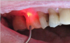 Fig 5. In this case, the laser fibers went into the gingival pocket and performed the decontamination, causing minimal bleeding and discomfort for the patient (Fig 5). Follow-up showed no inflammation or infection (Fig 6).