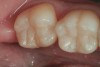 6. An occlusal view of teeth Nos. 18 and 19 after anatomic placement of the enamel “capping” layer (xtra-Fil, VOCO America), finishing, and polishing.