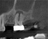 (3.) Sagittal slice of CBCT image of the same tooth displaying PAO or “halo lesion” with associated mucositis.