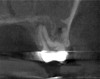 (4.) Coronal slice of CBCT image of the same tooth.