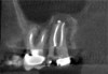 (8.) Postoperative CBCT images taken 3 months after NSRCT (ie, 6 weeks after sinus surgery), showing sinus clearing and reduction in the size of the PAO lesion.
