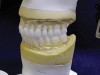 Figure 12. Radiographic guide with radiopaque teeth for a fully edentulous patient.
